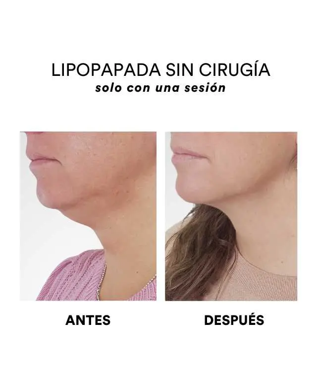 Lipopapada sin cirugía – Santiago – Aura Laser