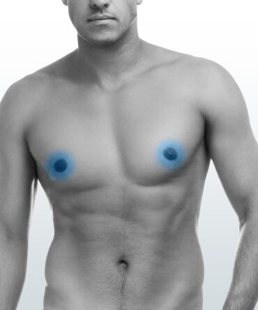 Depilación Areolas (XS) - Santiago