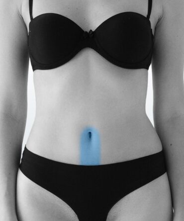 Depilación Línea Alba (S) - Santiago